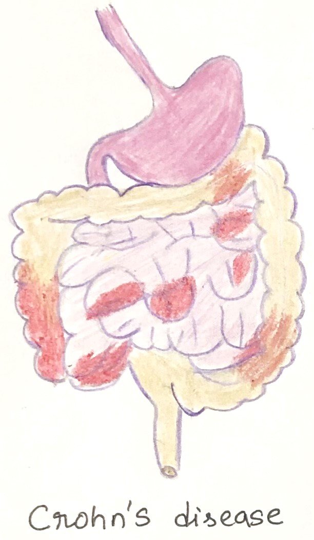 Inflammatory Bowel Disease