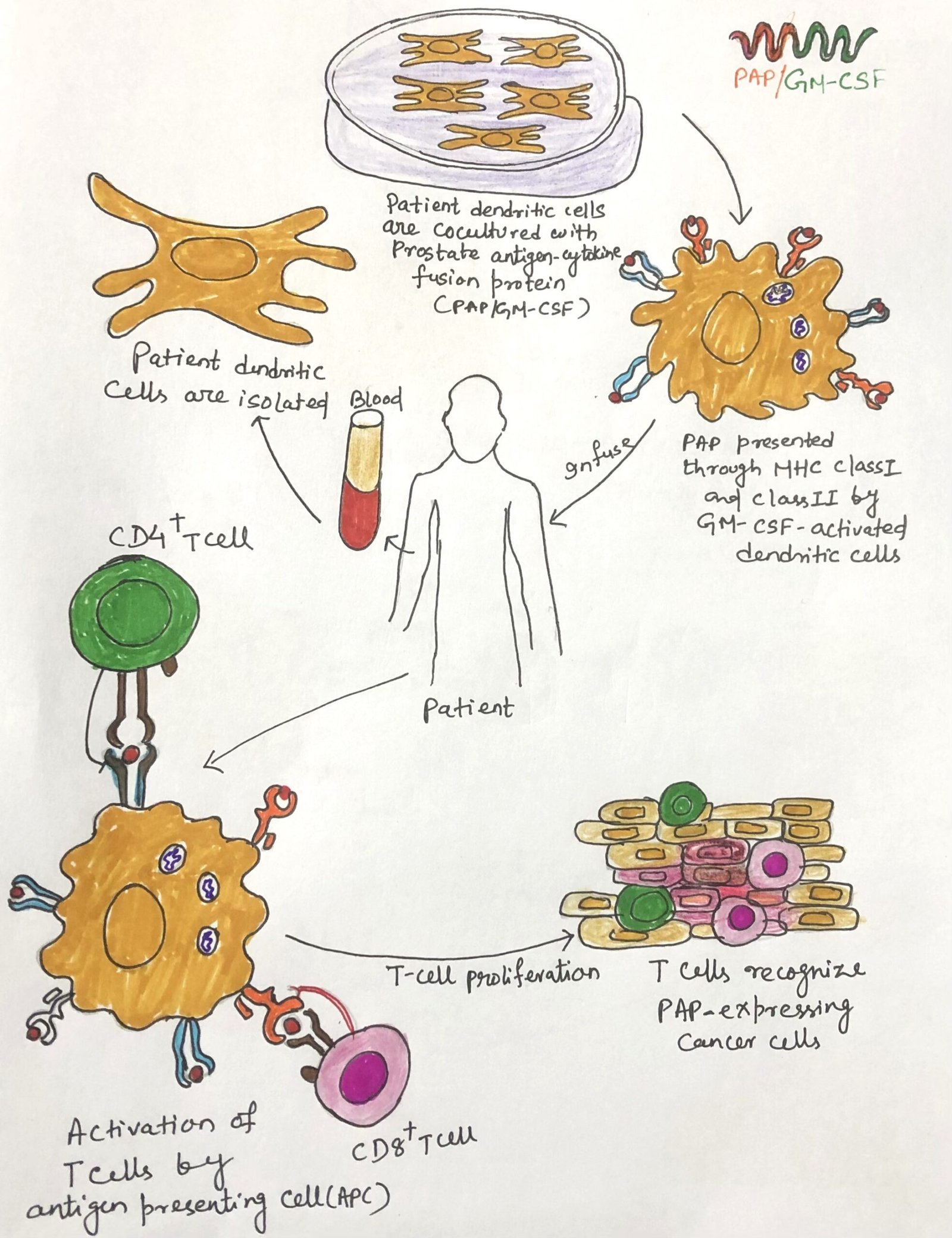Sipuleucel-T-a prostate cancer vaccine