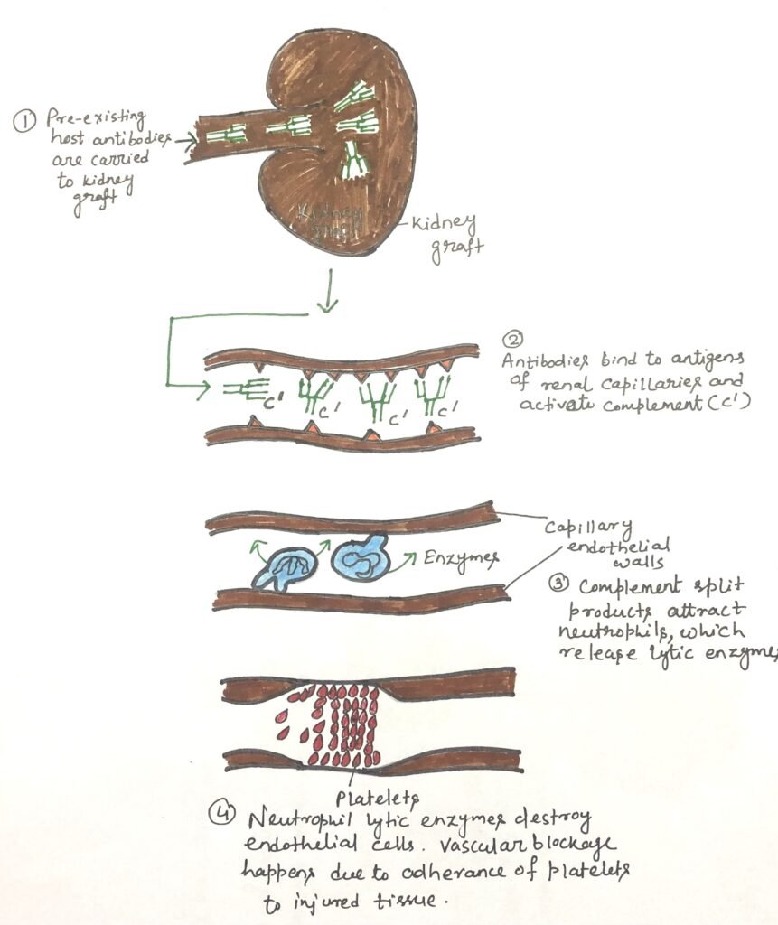 The sequence of events leading to hyperacute rejection of a kidney transplant