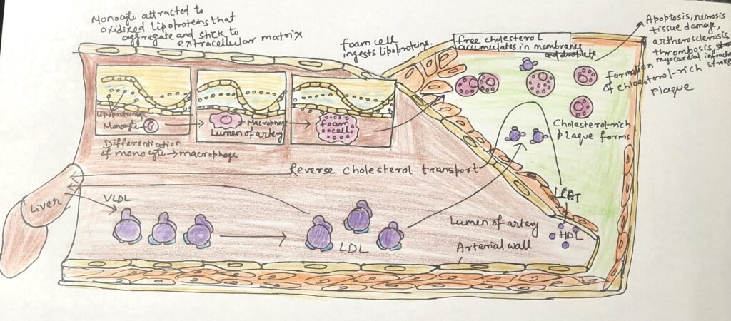 Atherosclerotic Plaques